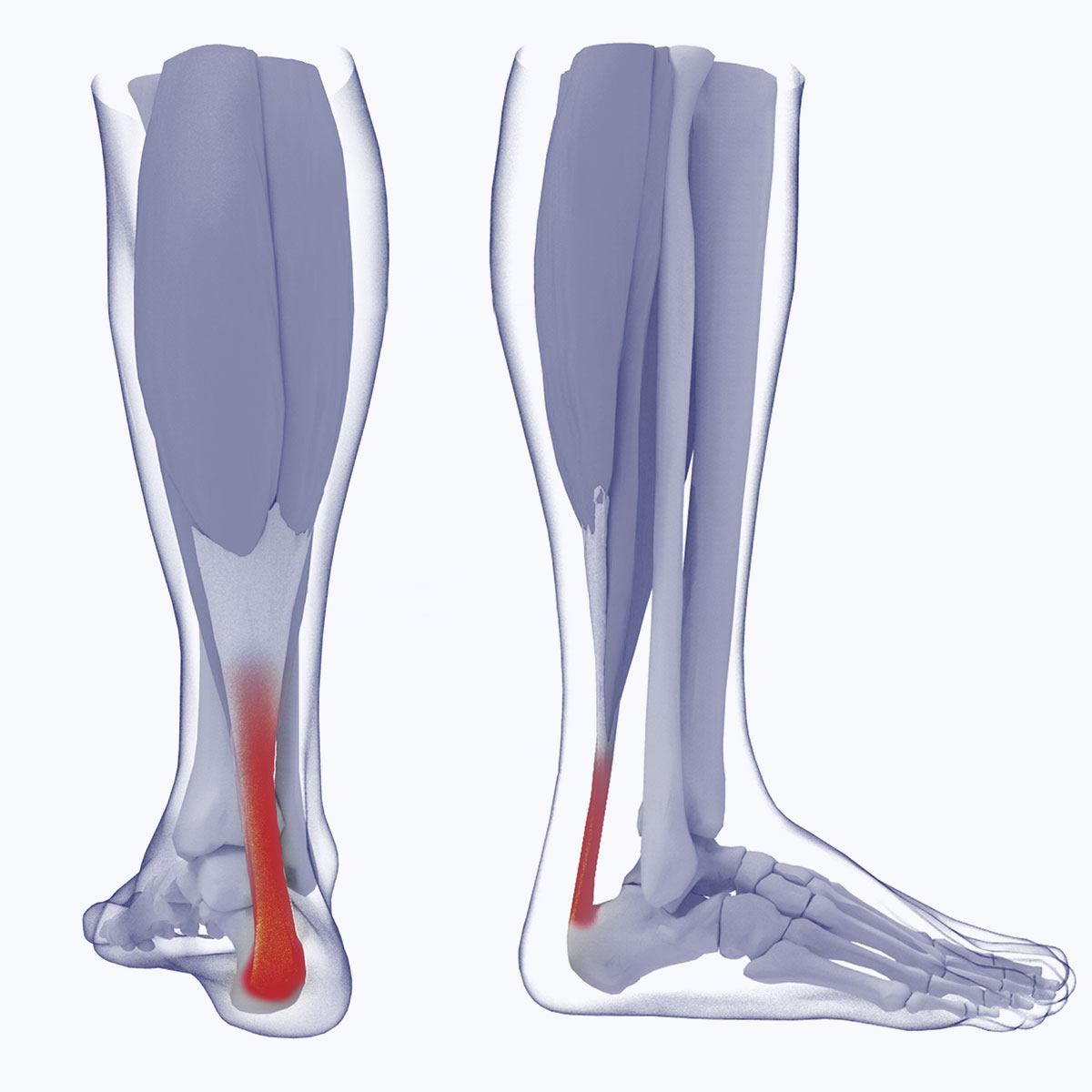 điều trị đa mô thức trong viêm gân gót chân