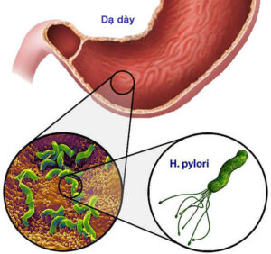 vi khuẩn HP trong dạ dày