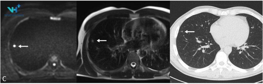 MRI tầm soát ung thư phát hiện ung thư phổi