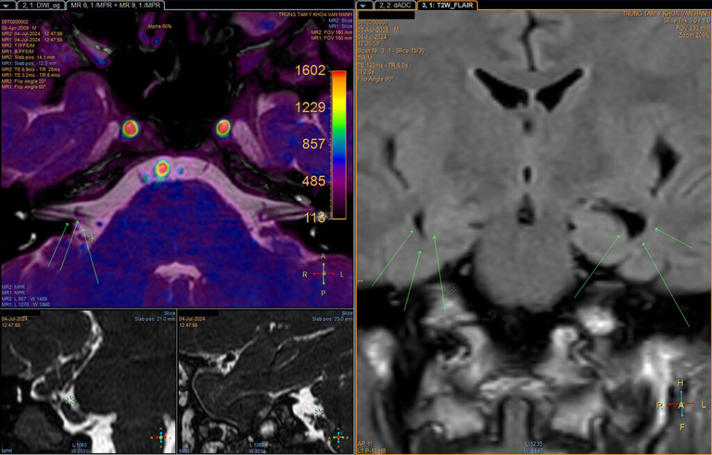 kết quả chụp mri chẩn đoán động kinh