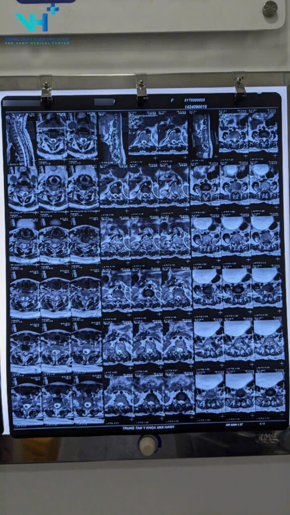 Chẩn đoán chính xác Neurofibromatosis (U xơ thần kinh) nhờ công nghệ MRI hiện đại 