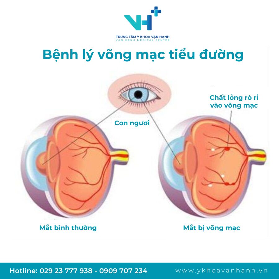 bệnh lý võng mạc tiểu đường