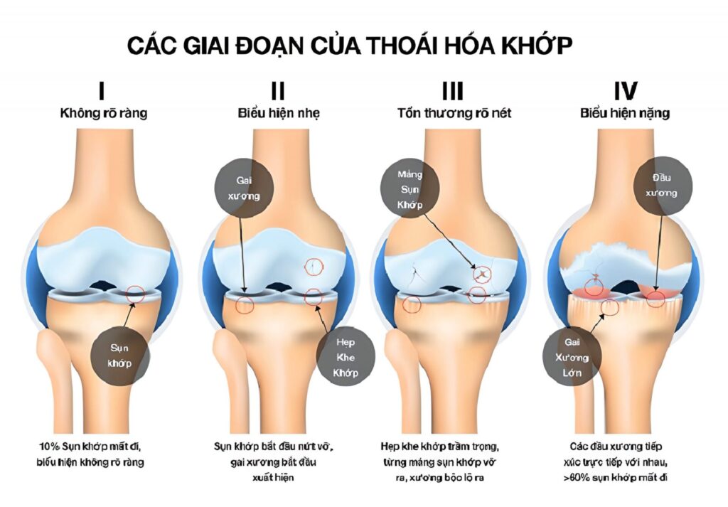 Các giai đoạn thoái hóa khớp gối